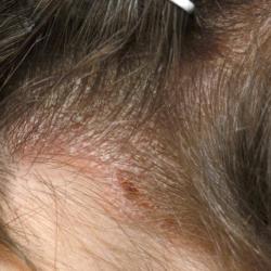 Example of psoriasis